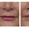 Image 2: 1 or 3 IPL Acne, Melasma, Brown Spots, or Rejuvenation Treatments
