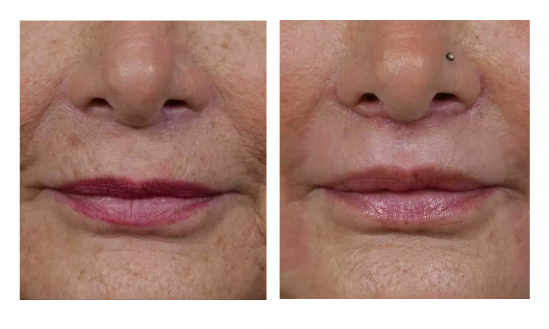 1 or 3 IPL Acne, Melasma, Brown Spots, or Rejuvenation Treatments