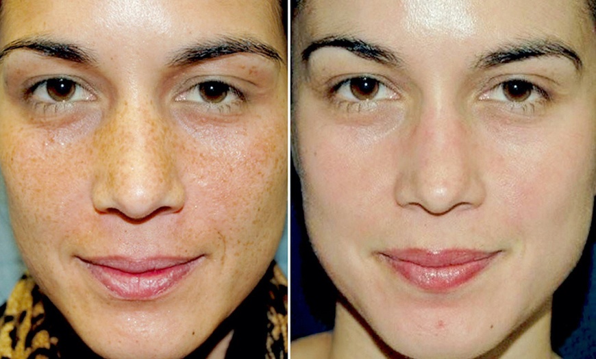 Image 4: VI Original, Purify or Advanced Peel with LED Light Therapy