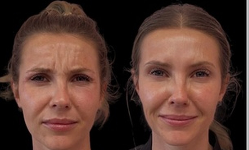 Image 6: Revitalize Your Look with 20 Units of Botox