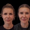 Image 6: Revitalize Your Look with 20 Units of Botox