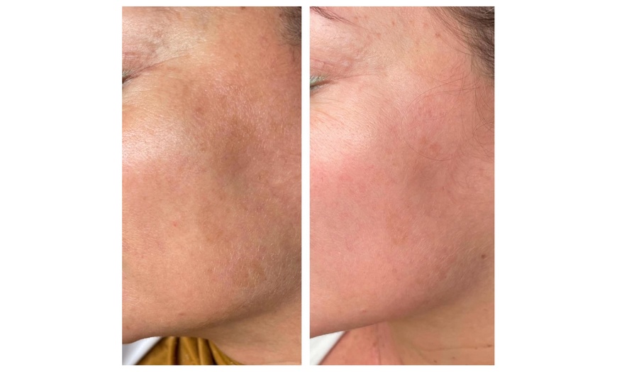 Image 7: Transform Your Skin with One or Two PRP Micro-Needling