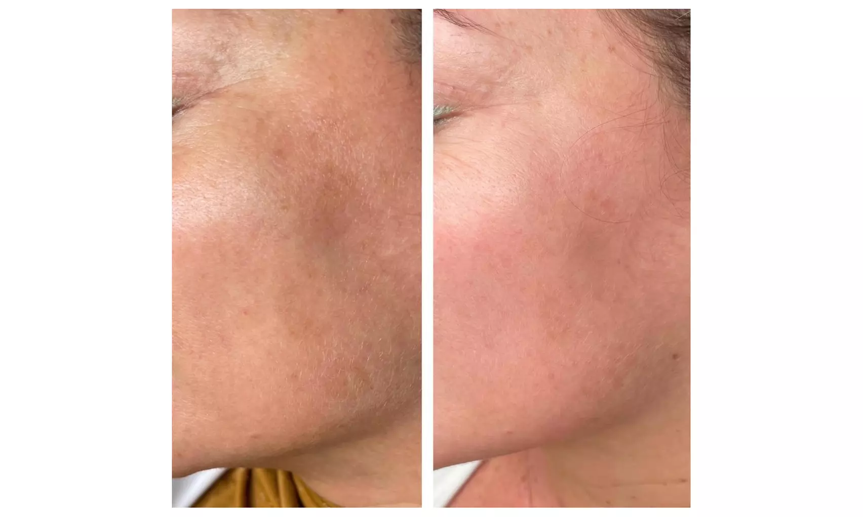 ✨ Glow from Within ✨

PRP Micro-Needling at Beauty Lash – Up to 62% Off Your Skin Revival! - Second Medium