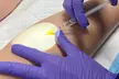 Consult, Ultrasound, Sclerotherapy Spider Vein Removal Injection (10cc) for a 2x2 Area (45-Min) (Up to 55% Off) - Second Medium
