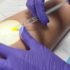 Image 3: Consult, Ultrasound, Vein Removal Injection (10cc) for a 2x2 Area