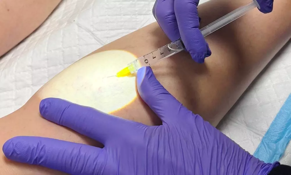 Consult, Ultrasound, Vein Removal Injection (10cc) for a 2x2 Area
