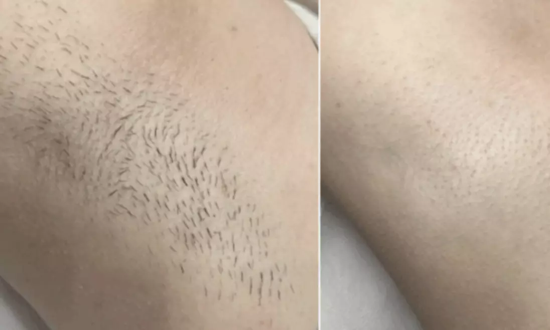 Laser Hair Removal Session - Brazilian, Underarms, Full Leg, or Back