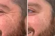 Transform Your Look with 30 or 60 Units of Dysport at Youthful Glow ( Up to 51% Off ) - Second Medium