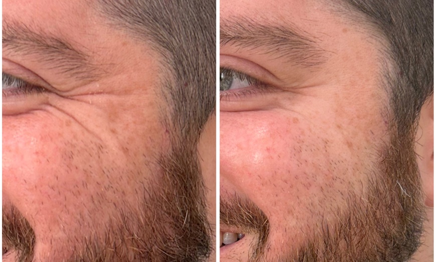 Image 3: Revitalize with 30 or 60 Units of Dysport at Youthful Glow