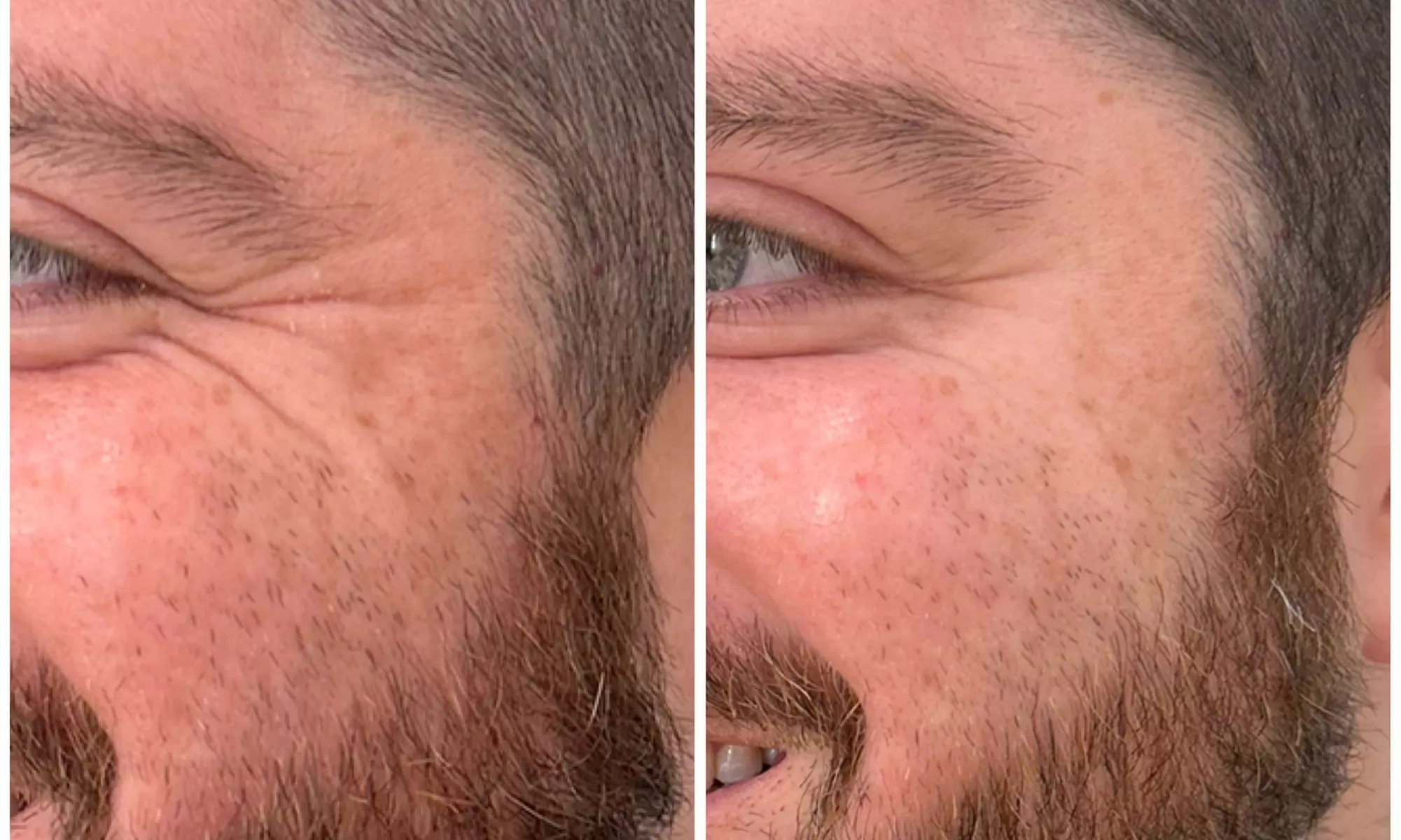 Revitalize with 30 or 60 Units of Dysport at Youthful Glow