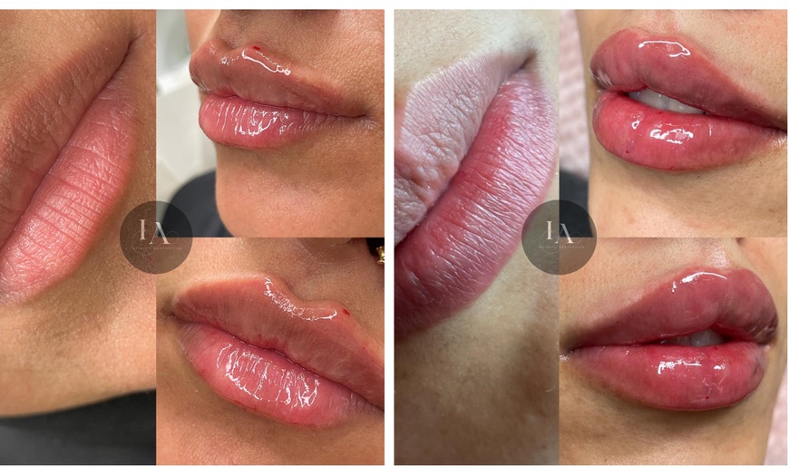 Image 2: Enhance Your Lips with 1.1ml Filler and Expert Consultation