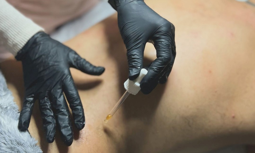 Image 8: One or Three PRP Nano Facial Treatment with Microneedling