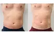 Transform Your Look with Choice of Cavitation Options at Silhouette Aesthetic - Up to 58% Off - Second Medium