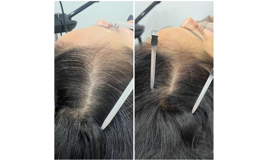 Image 2: 30-Minute One, Two, or Three Alma TED Hair Restoration Sessions