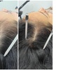 Image 2: 30-Minute One, Two, or Three Alma TED Hair Restoration Sessions