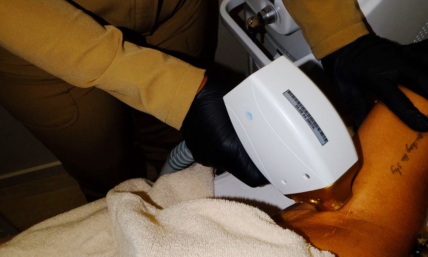 Image 3: 1 of 3 keer laserontharen op zone naar keuze