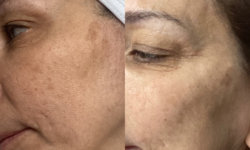 Image 2: Diamond Peeling Facial for Radiant Skin