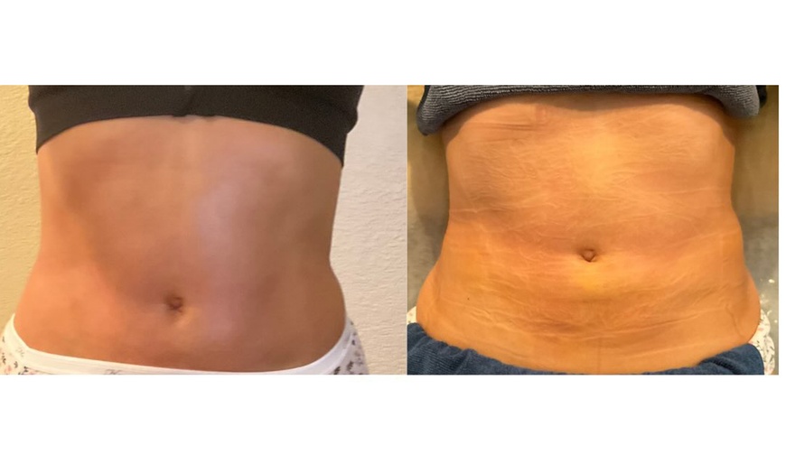 Image 5: 45 or 60-Minute Post-Op Massages for Optimized Surgical Recovery