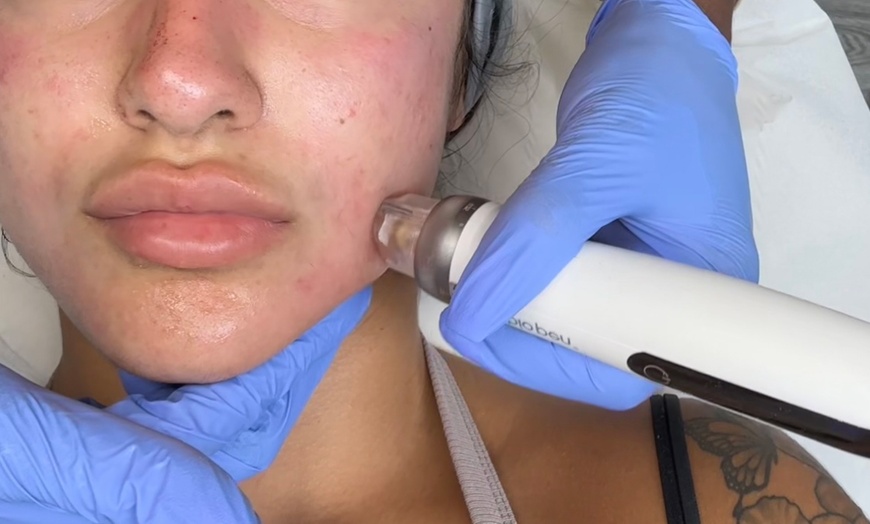 Image 4: Advanced Micro-needling w/ Luxury Hydrating Serums - Face and/or Neck