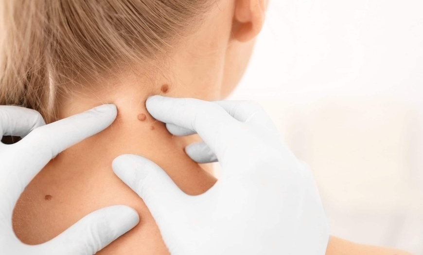 Image 1: Tratamiento láser para la eliminación de verrugas, lunares y puntos 