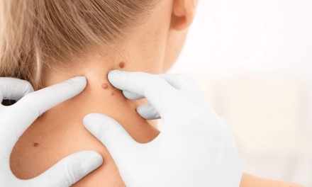 1 sesión de tratamiento láser para la eliminación de verrugas, lunares y puntos rubí - Curated by AC Medicina Estetica