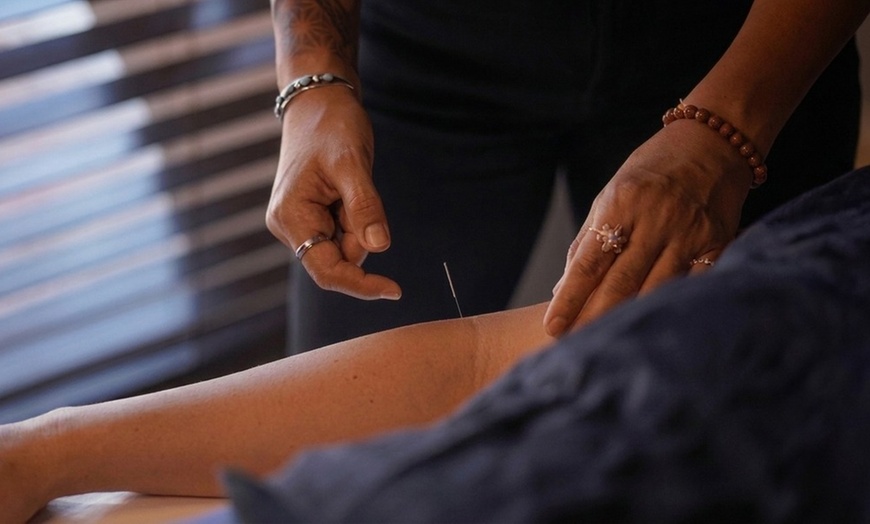Image 2: Acupuncture, Facial Acupuncture & Cupping for Wellness & Relaxation