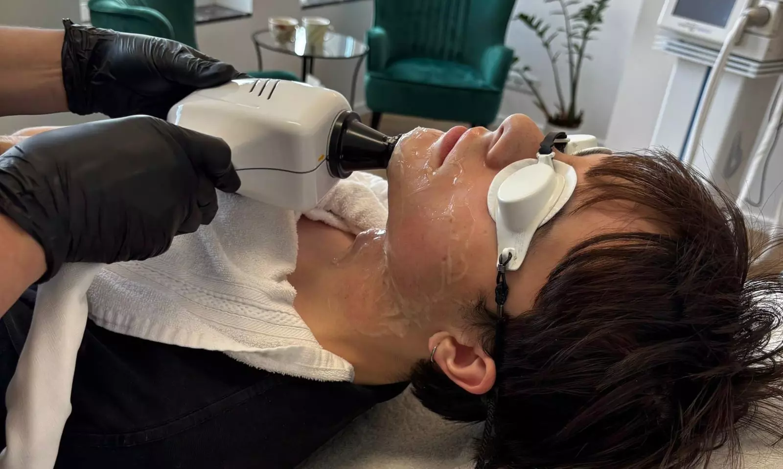 Depilacja laserowa wybranej partii ciała – 1 lub 3 zabiegi