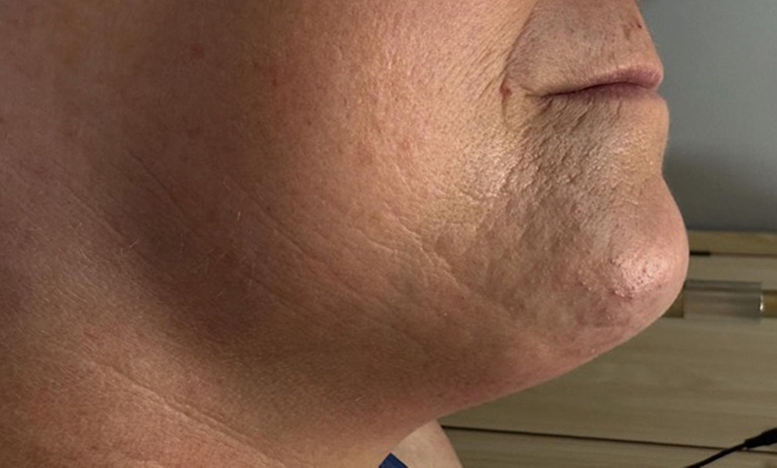 Image 4: Relax with Cryo & Thermal Body sculpting (2 or 3 sessions)