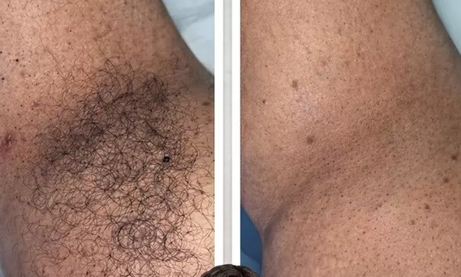 Brazilian Wax with Inner Thigh Lower Legs Stomach Strip or Underarms Options at Meraki by Missie (Up to 30% Off) - Image 3