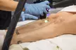 Achieve Smooth Skin with Six Laser Hair-Removal Sessions at Suburban Laser and Skin, Save Up To 41% - Second Medium