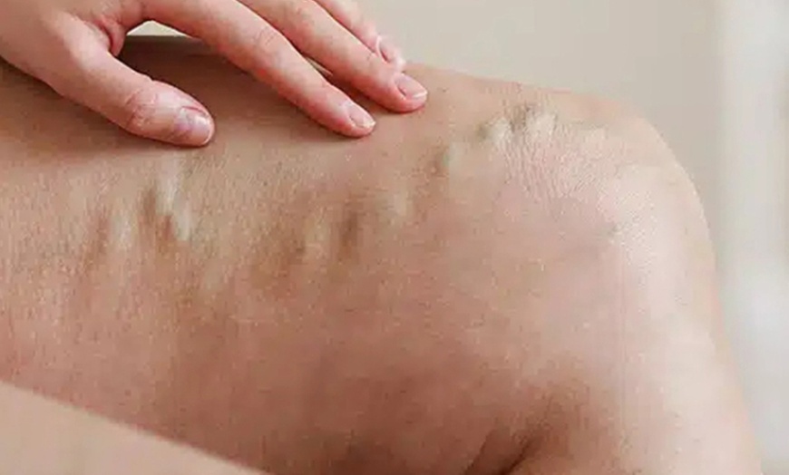 Image 9: Eliminación de varices o verrugas con tecnología avanzada 