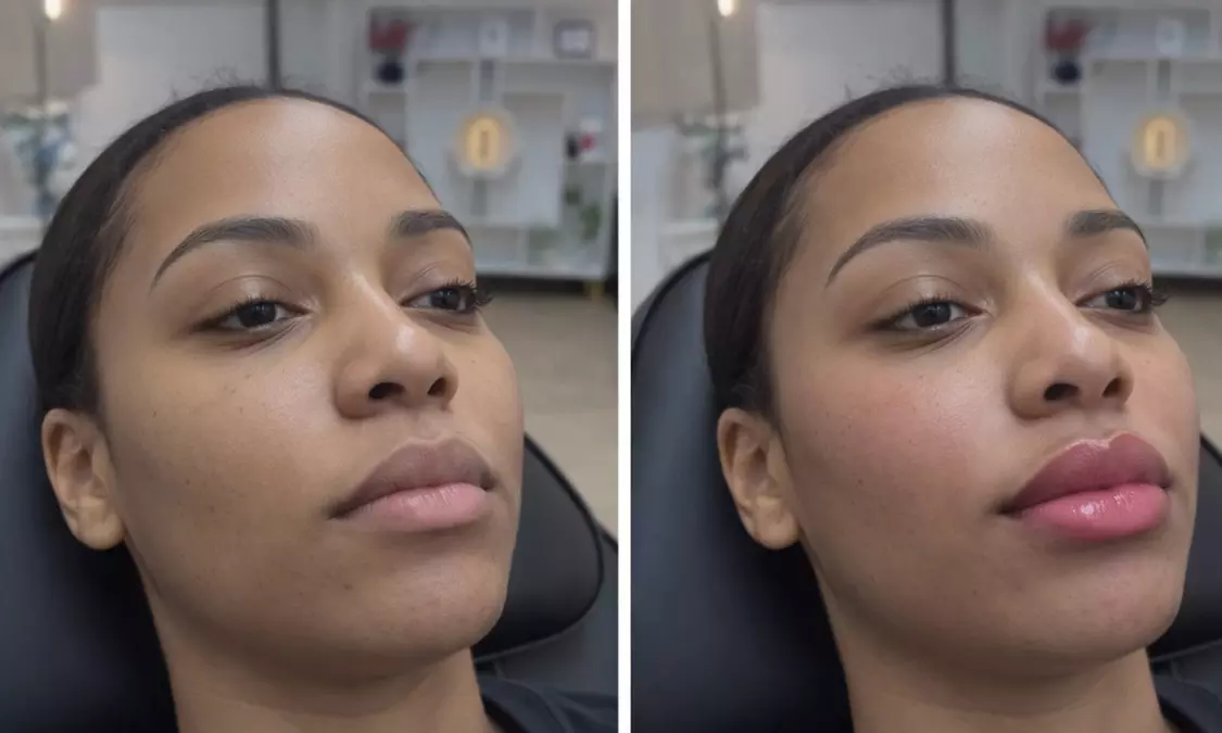 Pick Your Perfect Botox Package: 20 or 40Units at Great Prices