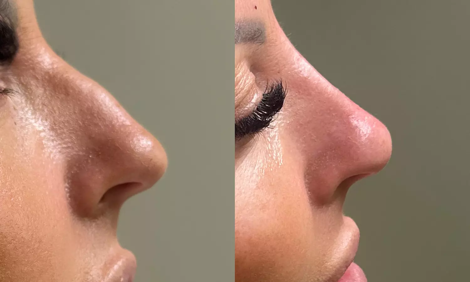 Enhance Your Natural Beauty with Dermal Filler Treatments