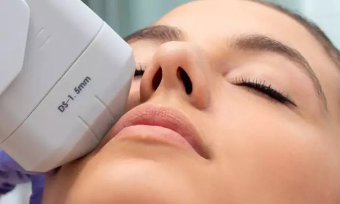 Tratamiento reafirmante HIFU