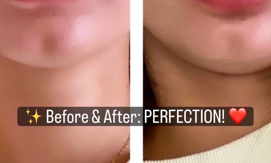 Image 3: Refresh with One Syringe of RHA 2, RHA 3, or Revanesse Versa