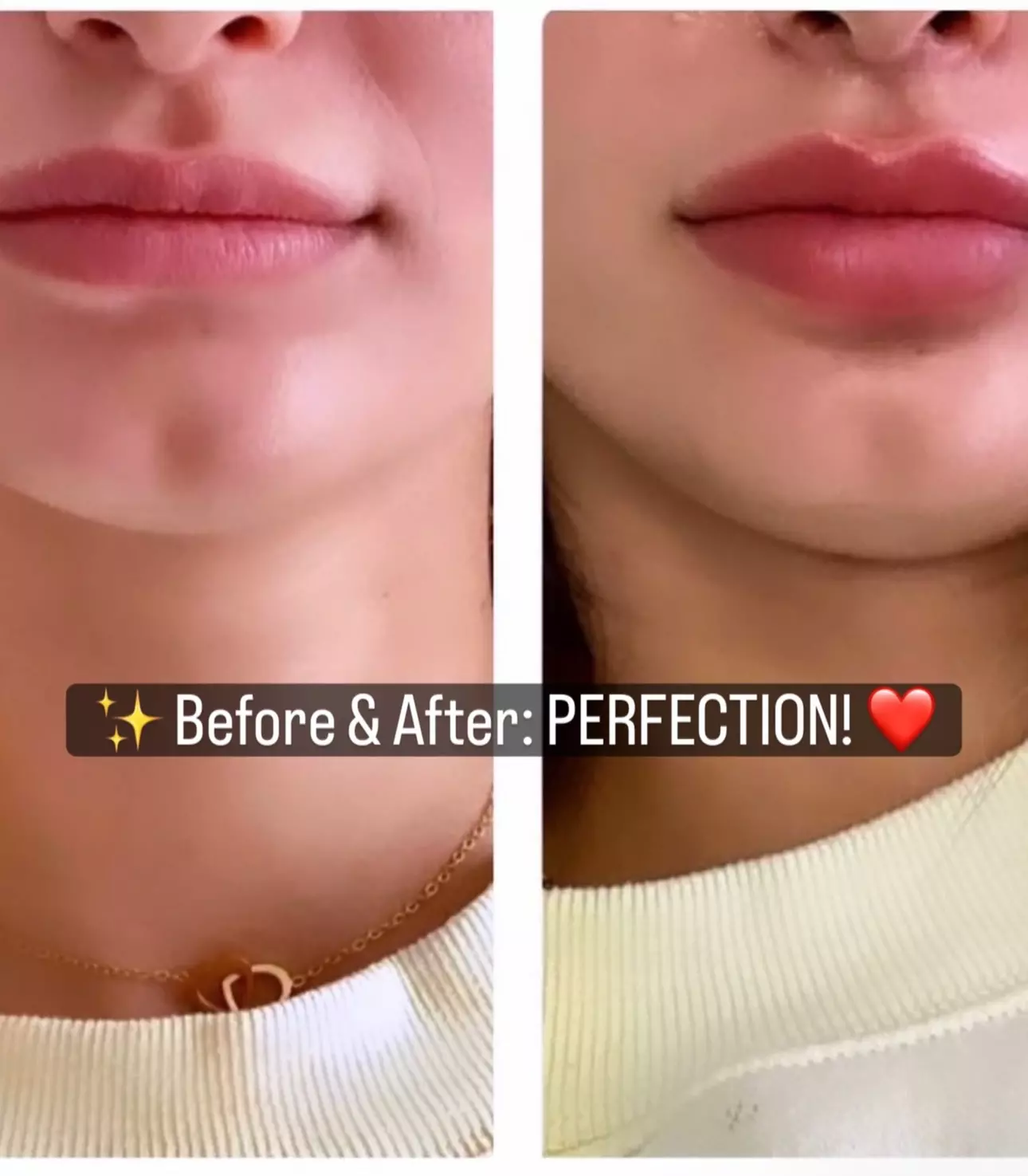 Refresh with One Syringe of RHA 2, RHA 3, or Revanesse Versa