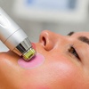 Image 1: Tratamiento con exosomas con dermapen en 1 o 3 zonas a elegir 