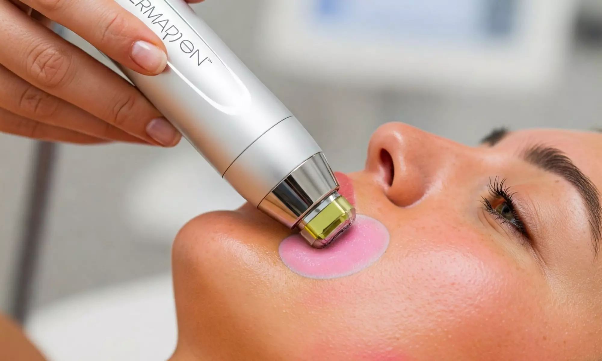Tratamiento con exosomas con dermapen en 1 o 3 zonas a elegir