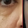 Image 2: Boost Your Glow with Natural PRF Treatments