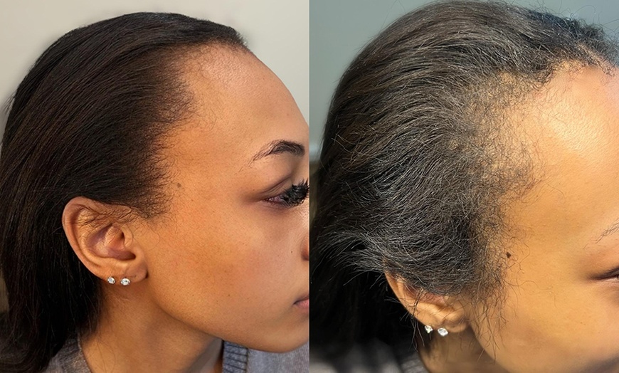 Image 6: Haarpigmentierung, Narbenkorrektur oder Kurzhaarschnitt für 1 Person