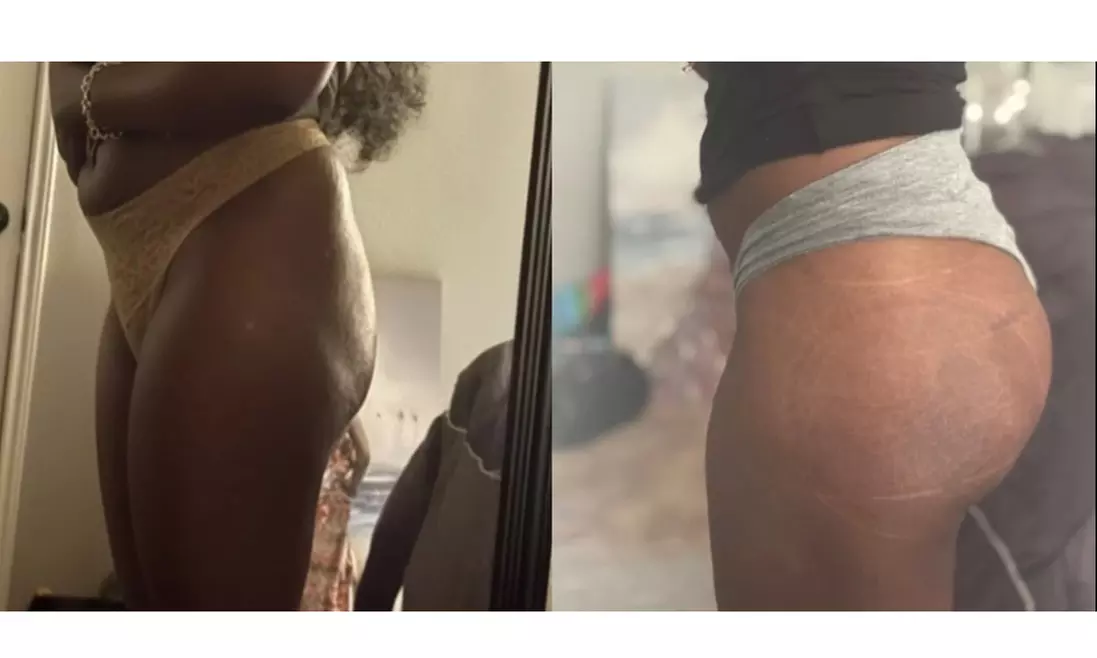 Lift and Contour with Vacuum BBL - One, Three, or Six Sessions