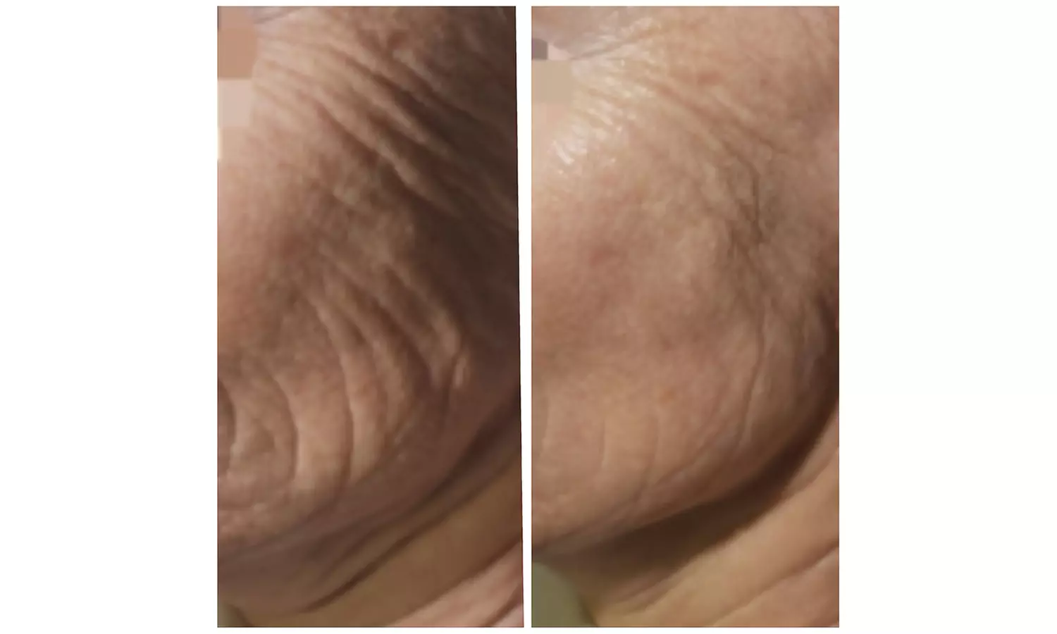 HIFU For Smile Line, Jawline & Chin, Full Face with or without Neck