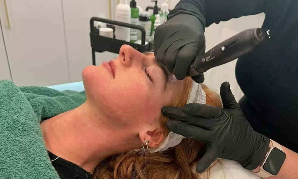 One or Three Sessions of Premium Microneedling Facial at Cyan Holistic - Primary Image