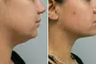 Precision TX Lower Face and Neck Tightening Treatment at Rafael Diaz-Yoserev, MD., FACS (Up to 1% Off) - Image 2