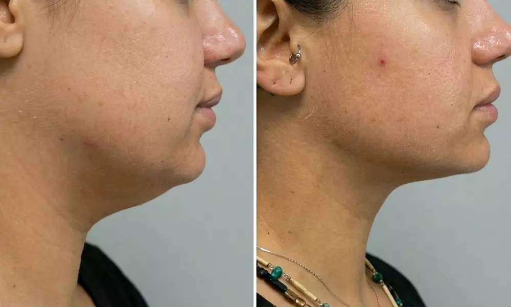 Precision TX Lower Face and Neck Tightening Treatment