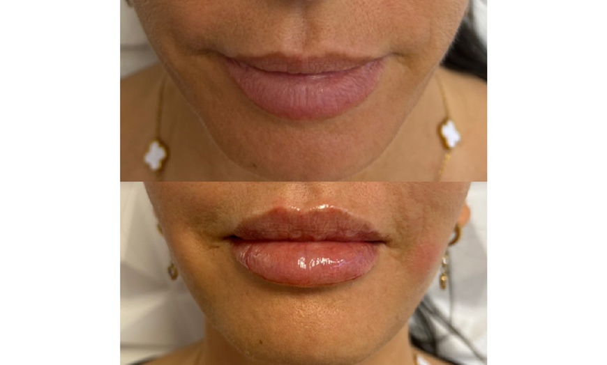 Image 5: Up to 37% Off on Injection - Dermal Filler at Holistic Health and Medical