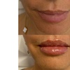 Image 5: Up to 37% Off on Injection - Dermal Filler at Holistic Health and Medical