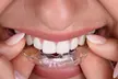 Clear Aligners Or Invisalign Plus Dental Exam, X-Ray and Cleaning For One Person Up to 80% Off - Second Medium