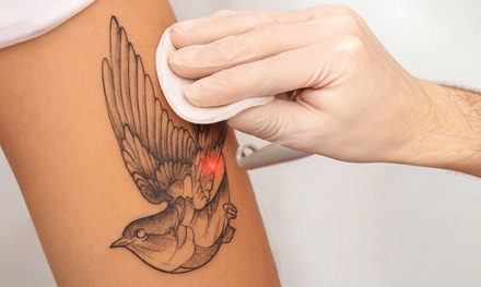 Three Laser Tattoo Removal Sessions on an Area of up to One Square Inch - InkOut Tattoo Removal and Fading
