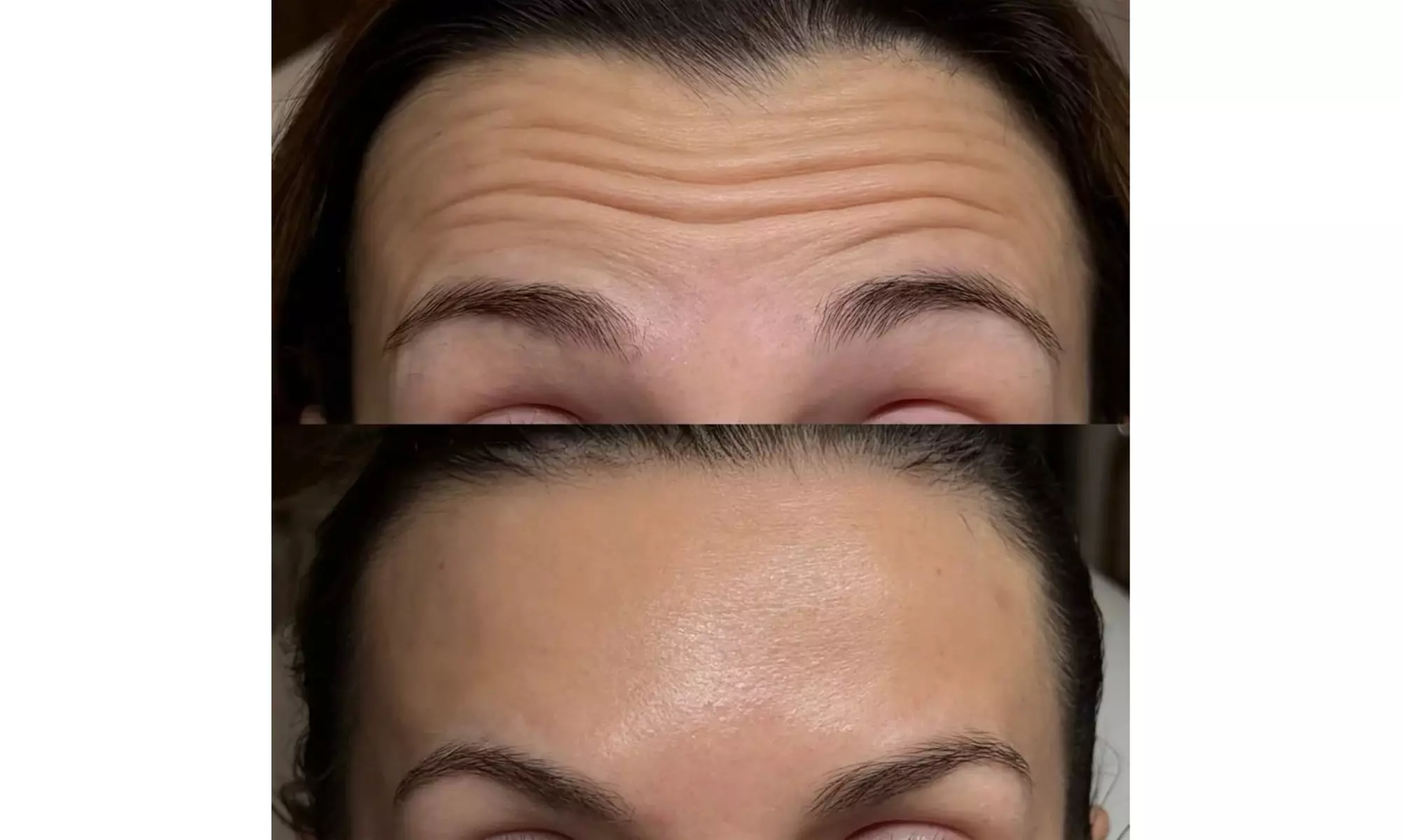 Enhance Your Look with 20, 40, or 60 Units of Botox